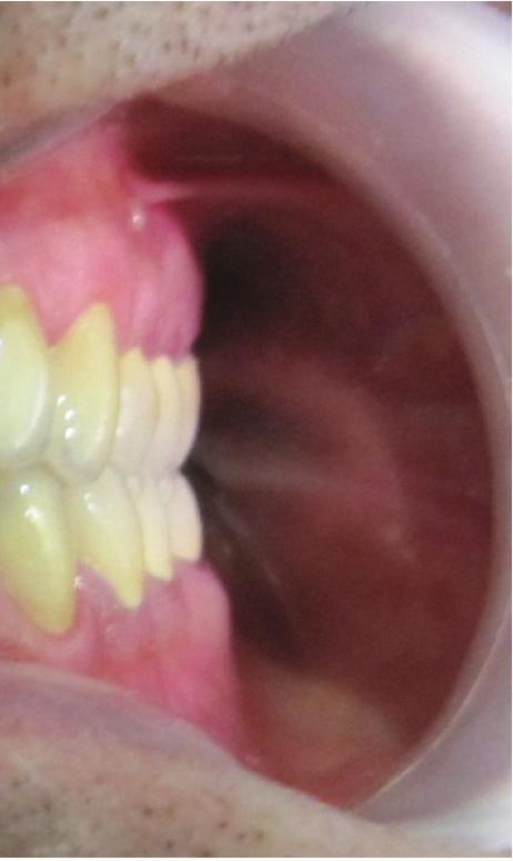 disengage the posterior teeth in all mandibular excursive movements.
