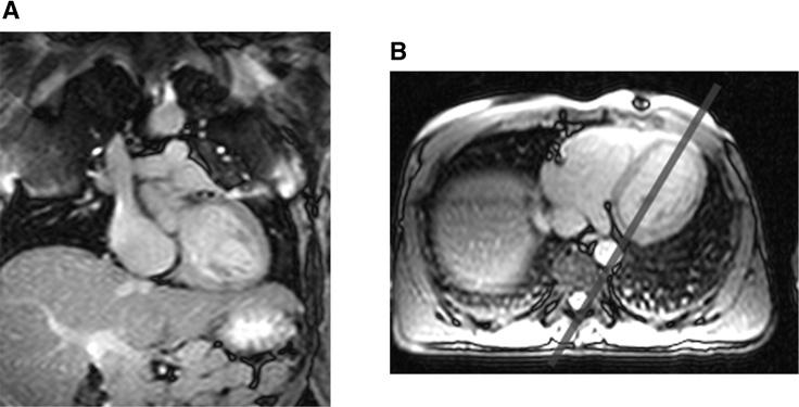 Figure A11.4.1 Coronal (A) and transverse (B) scout images acquired with single-shot steadystate free precession imaging technique while the patient holds his or her breath.