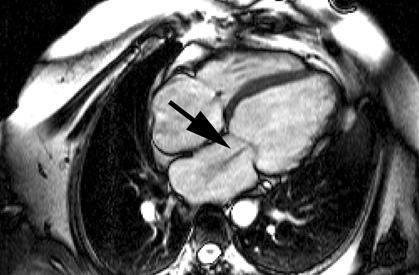 Figure A11.4.4 Regurgitant jet (highlighted by the arrow) in a patient with myocardial infarction and acute mitral valve regurgitation that developed with severe ventricular failure.