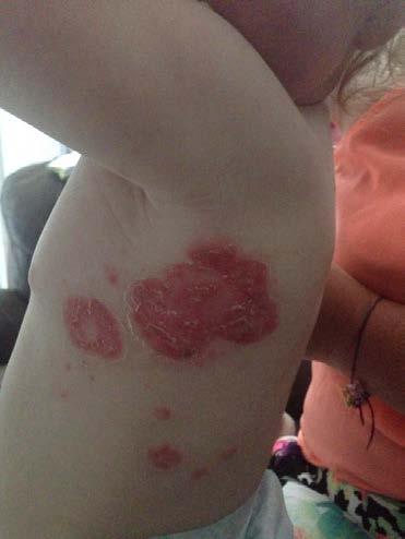 Pontins horror stay left one-year-old with huge red sores from 'bed bug bites' By Emilia Bona 17 June 2018 A horrified mum woke to find her baby daughter covered in painful red sores after she was