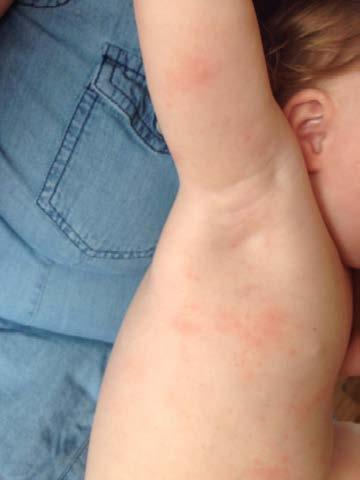 Mum Emma Almond, 32, said she was horrified when she woke up to find her baby daughter covered in bites A spokesperson for Southport Pontins said: "Further to the guest solutions form received