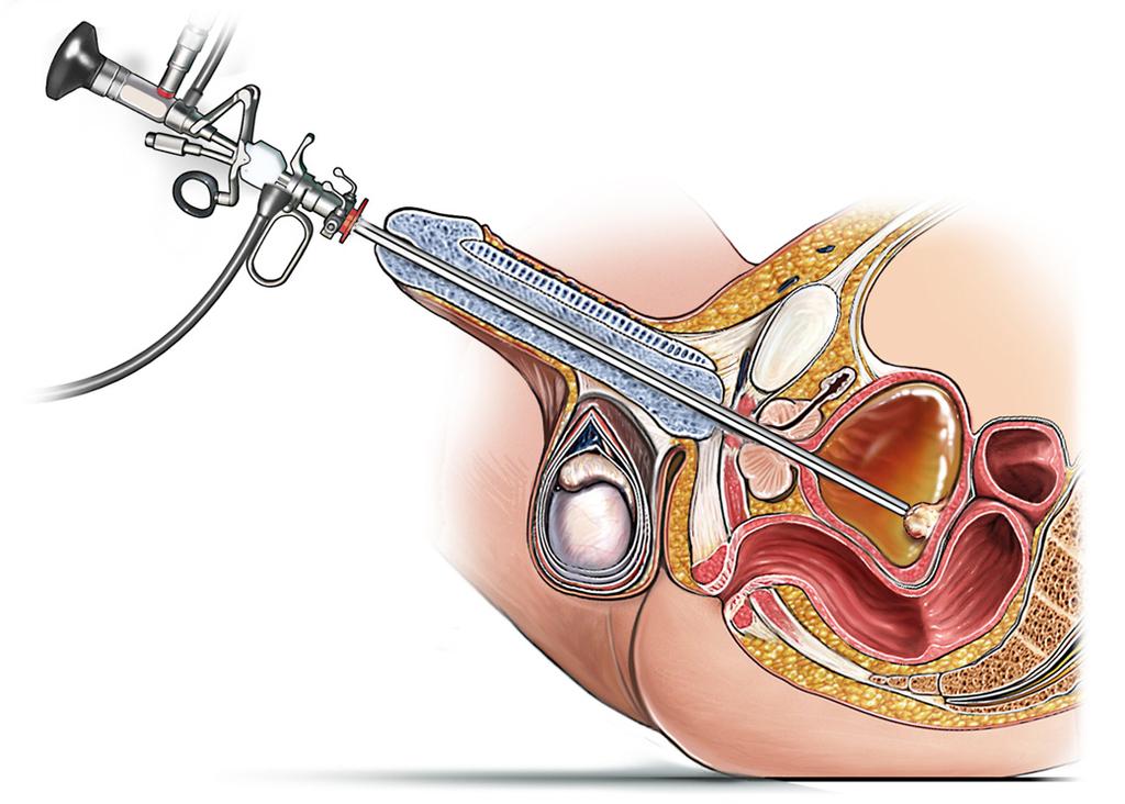 Your surgeon has recommended a trans-urethral resection of a bladder tumour (TURBT) (see figure 1). However, it is your decision to go ahead with the operation or not.