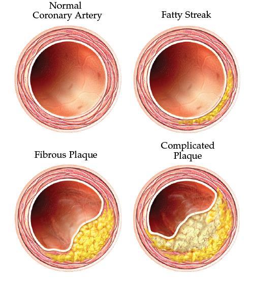 Ischemic Heart Disease (Coronary Heart Disease) Results from inadequate blood supply to the myocardium, usually as a result of obstructive coronary atherosclerosis.