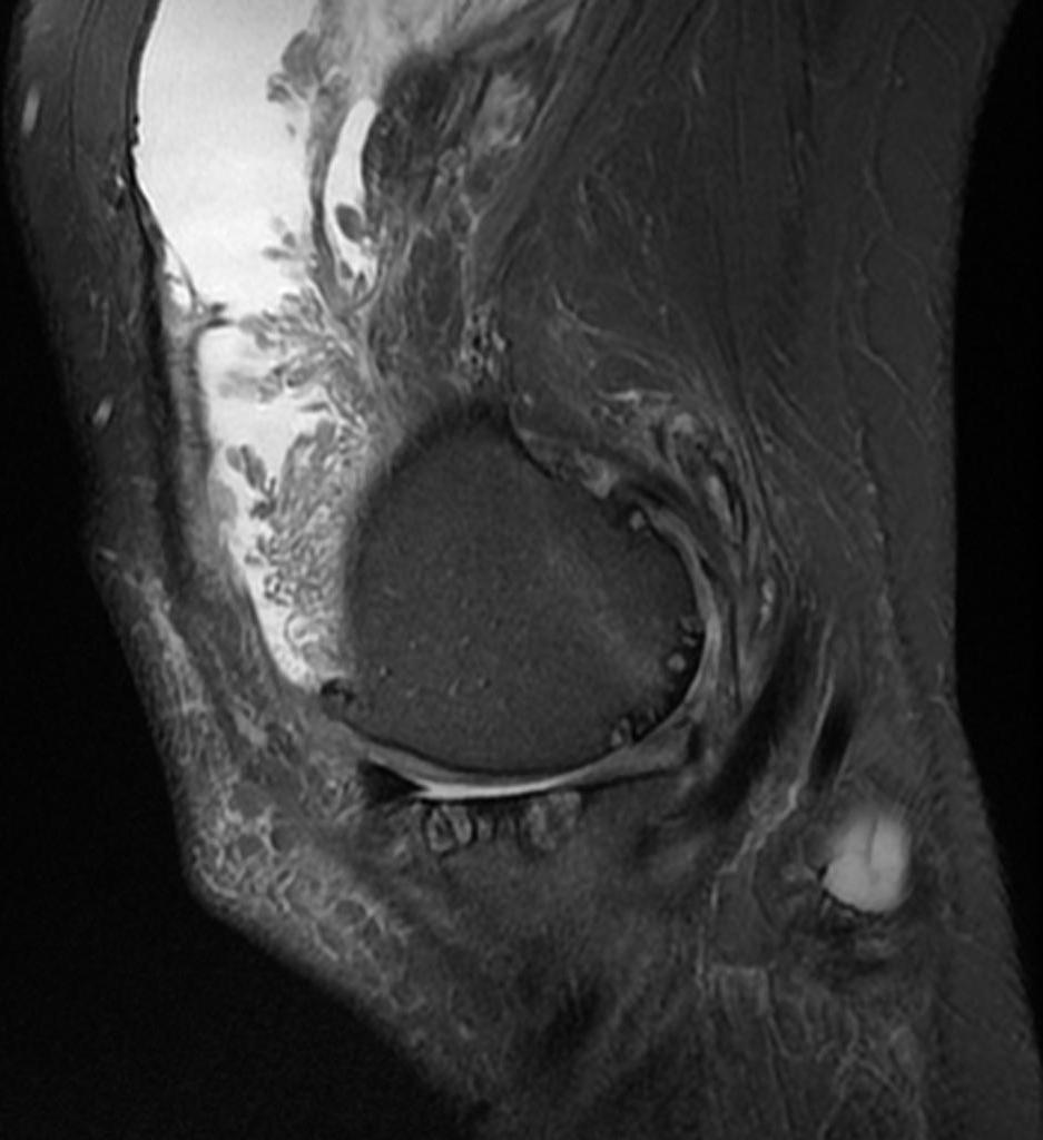 Benign Adipocytic tumors Most common in suprapatellar recess of knee joint Frond-like or