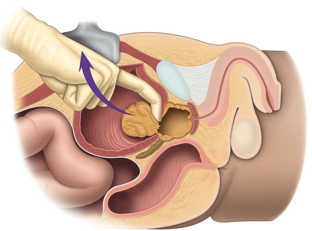 surgeon then uses his finger to remove the adenoma (Fig. 9). After the operation a catheter will drain the urine.