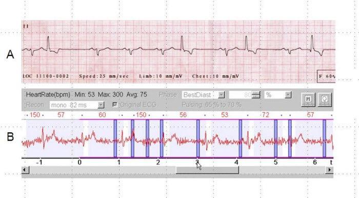 TEACHING POINT EKG noise may cause rare but serious artifacts during cardiac- CT acquisition and all efforts should be made to prevent this in the first place.