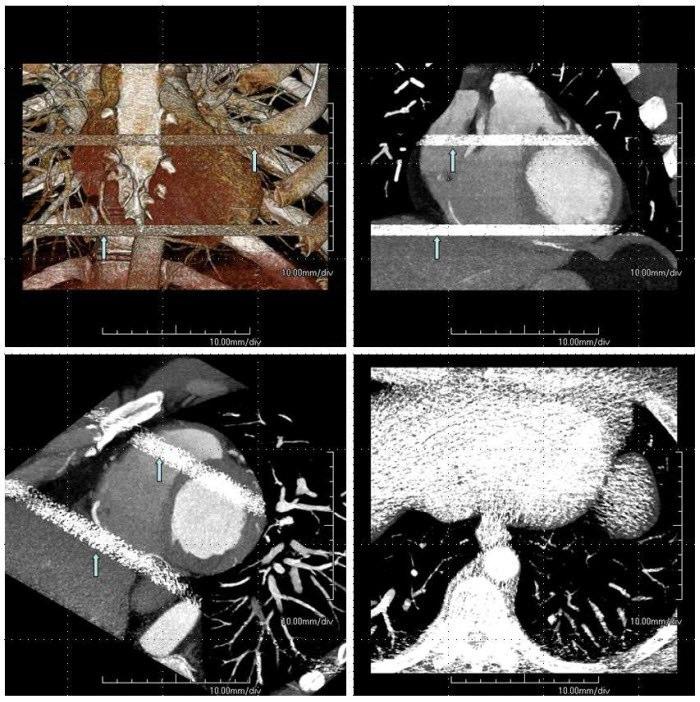 Figure 2: 47-year-old male underwent cardiac CT which shows step-stair and banding artifacts.