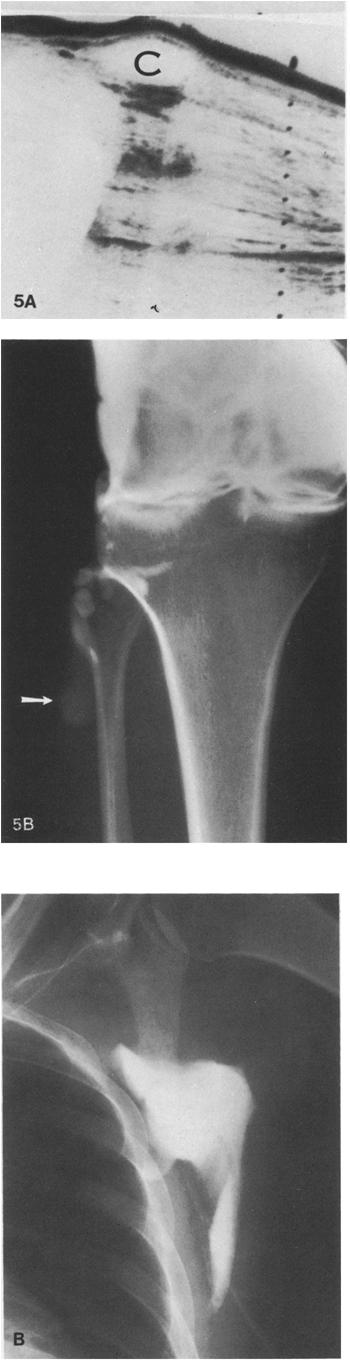 35-year-old woman with rheumatoid arthritis and proximal calf swelling. On physical examination the mass was hard and thought to represent a tumor.