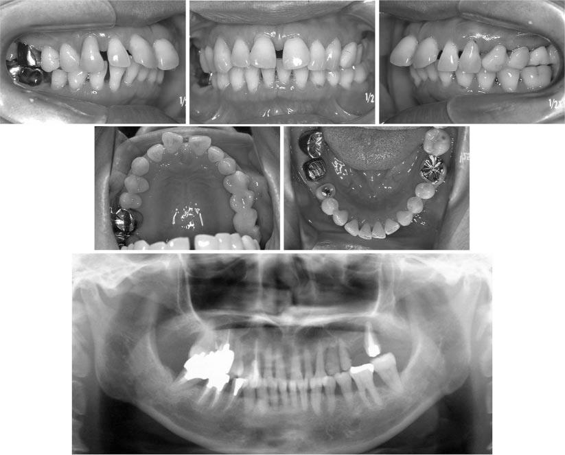 SKELETAL ANCHORAGE FOR ADULT PERIODONTITIS 149 FIGURE 1. Pretreatment intraoral photographs and panoramic radiograph. trude the upper incisors in a patient with severe adult periodontitis.