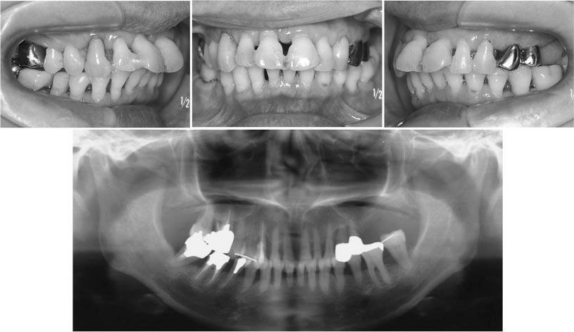 SKELETAL ANCHORAGE FOR ADULT PERIODONTITIS 151 FIGURE 3. Postperiodontal treatment intraoral photographs and panoramic radiograph. At the beginning of leveling, a 0.