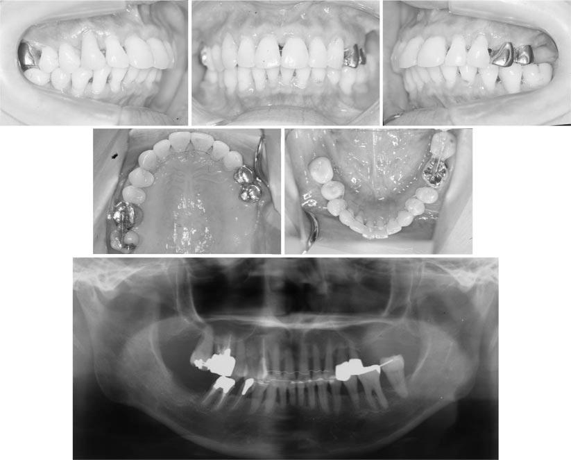 SKELETAL ANCHORAGE FOR ADULT PERIODONTITIS 153 FIGURE 7. Two-year postretention intraoral photographs and panoramic radiograph. FIGURE 8.