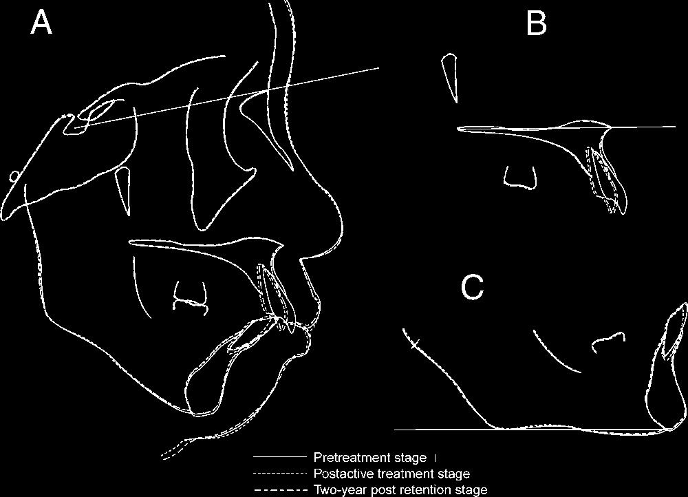 (B) Superimposing on the palatal plane at ANS. (C) Superimposing on the mandibular plane at Menton. ruption of the upper anterior segment, resulting in functional and esthetic problems.