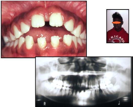 bone loss on maxillary and mandibular arch Same pt BW and clinical view