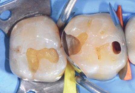 cusp peaks) Class V and root surface restorations Intermediate and Transitional restorations Core