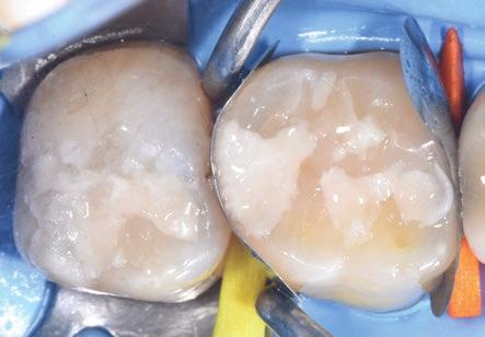 lesions on teeth 16 and 17. A new caries lesion in the mesial surface of tooth 16.