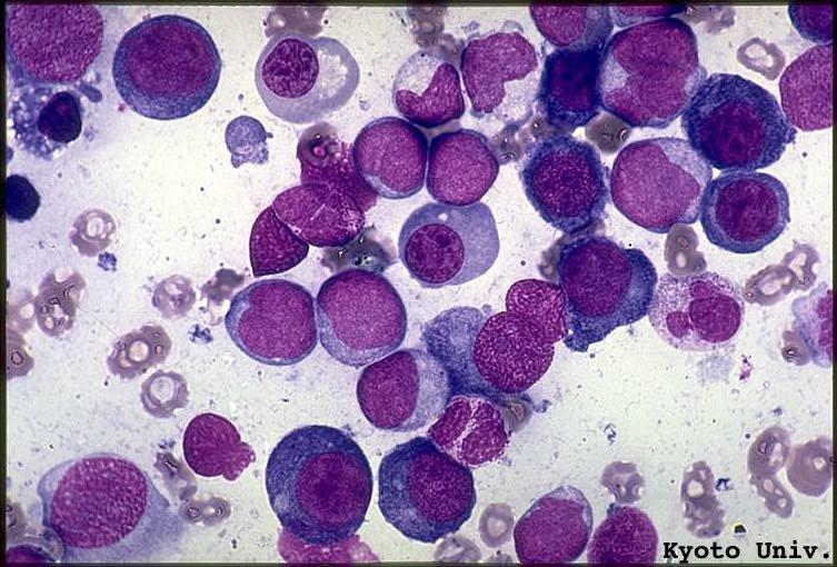 Acute leukemias: DIAGNOSIS AML ALL Atlas of Hematology, Nagoya University