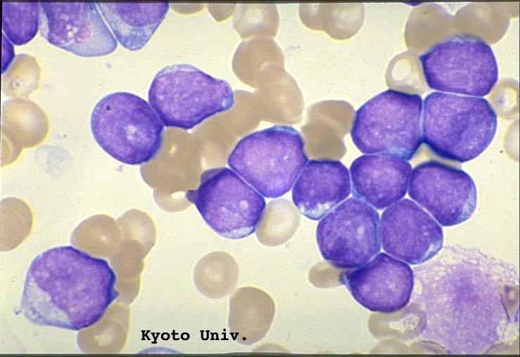 Ichihashi, December 1996 Bone marrow cytology: >20% blasts Peripheral blood: