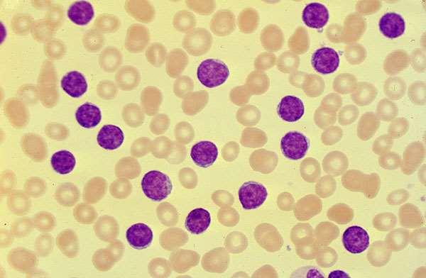 Chronic leukemias CLL as a low risk