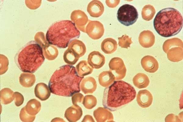 Blasts in peripheral blood smear