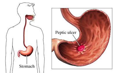 Peptic Ulcer A peptic ulcer is a sore in the lining of the small intestine The acid