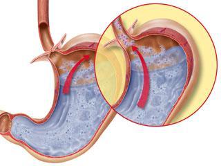 Acid Reflux Normally your stomach has a valve that