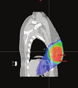 Accelerated Partial Breast Irradiation and Hypofractionated Whole Breast Radiation Figure 2: Representative Dose Distribution Achieved with 3D Conformal Radiation Therapy Figure 3: Theoretical Cell