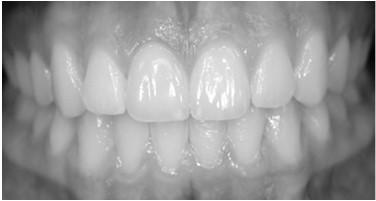 Diabetes & Periodontal Disease Poorly controlled diabetics are a risk-factor for periodontal disease. Altered wound-healing because of high glucose cellular environment (AGE S).