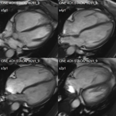 CMR Best Modality: Beyond isolated ASD 37 y/o with SOB and fatigue with history of
