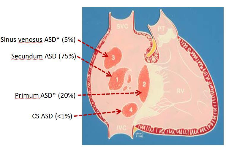 Background: Septal Defects Atrial Septal Defects (ASD) 7-10% of all congenital defects 100/100,000 live births Frequently associated with complex CHD