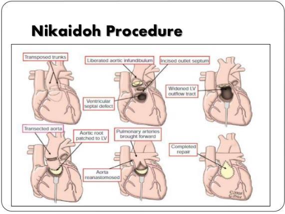 with a Nikaidoh procedure with