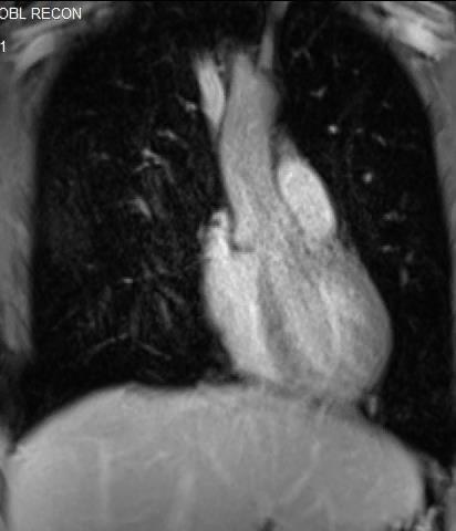 testing Cardiac MRI: Sinus