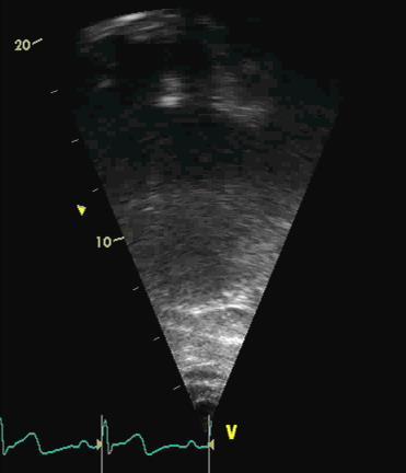 Background: Echocardiography Advantages Readily available Can