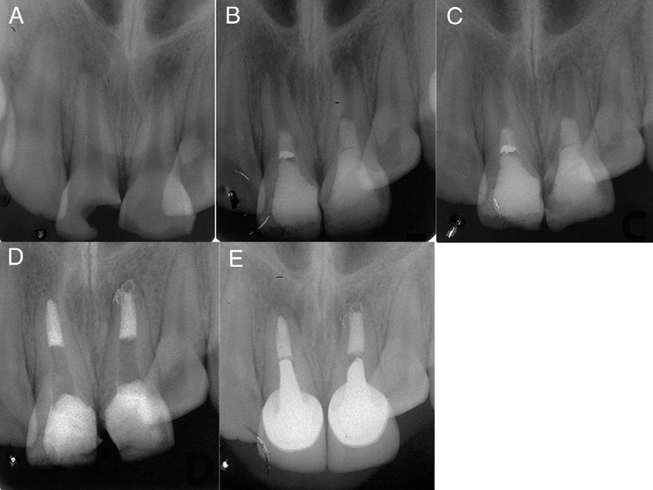 grow (35). In addition, there are several reports of successful regenerative endodontic treatment and continued root development without bleeding induction (16, 19, 22).