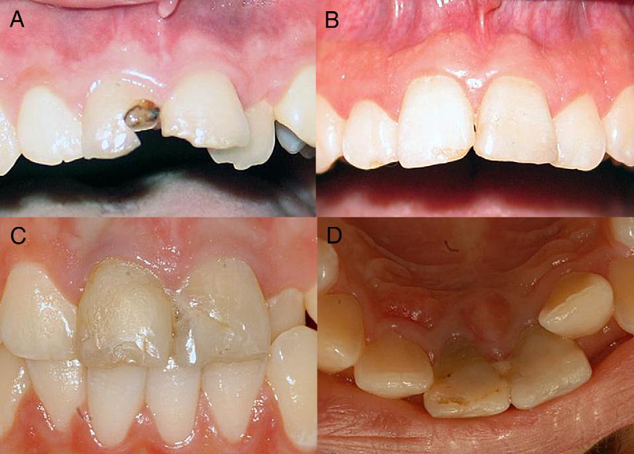 maxillary central incisors were sensitive to percussion and palpation. There was no palpable periapical swelling on the maxillary central incisors at the time of examination.