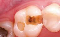 This consistency makes easy to mould and it facilitates adaptation to the existing morphology of the tooth.