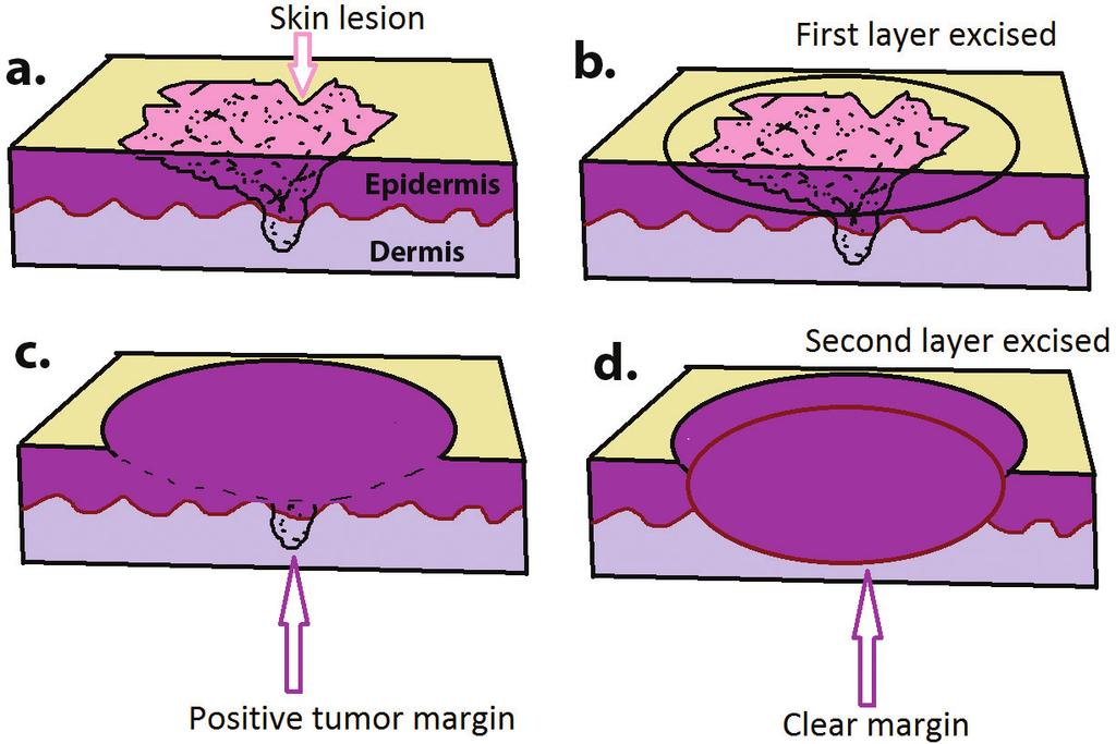 Mohs Micrographic Surgery http://dx.doi.org/10.5772/intechopen.70285 103 Figure 3. Illustration of staged surgical excisions. a. preoperative view b. excision of the first layer c.
