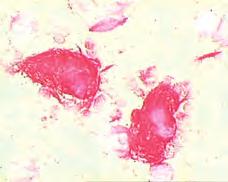 Tipične pjenušave stanice se mogu naći u cirkulaciji, odnosno perifernoj krvi i retikuloendotelnom sustavu koštane srži, jetre, slezene, itd.