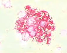 sustavnim lipidozama. Citokemijske i imunocitokemijske karakteristike pjenušavih stanica u svakoj od bolesti nakupljanja omogućuju njihovo razlikovanje. Jedna od najčešćih je Gaucherova bolest.