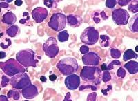 Pseudo-Gaucherove stanice: a) u bolesnika s akutnom limfocitnom leukemijom (MGG x1000); b) sea blue