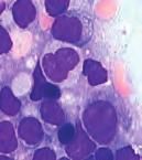 Citokemijski, pseudo-gaucherove stanice pokazuju identičnu pozitivnost, ali su imunocitokemijski