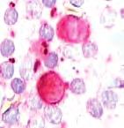 Gaucherove stanice nisu tipične fagocitne stanice, već igraju aktivnu ulogu u kroničnoj stimulaciji