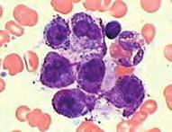 Hematološke neoplazme Prema važećoj klasifikaciji hematopoetskih i limfoidnih tumora Svjetske