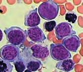 ) i mastocitozu kao subtipove mijeloproliferativnih neoplazmi (MPN). g) h) i) j) Slika 3.