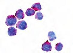 hiperploidijom zastupljena je u 25% svih slučajeva B-ALL-a djece najčešće ima >50<66 kromosoma, prognoza je dobra u >90% djece; B limfoblastična leukemija/ limfom s hipodiploidijom kada