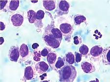 Radi se o imunofenotipski i funkcionalno nezrelim, Langerhansovim stanica izmješanim s eozinofilima, makrofazima i često multinuklearnim orijaškim stanicama.