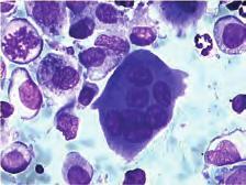 Stanice su imunocitokemijski pozitivne na langerin, S-100 protein, CD1a, CD207, CD68, vimentin i HLA-DR. Elektronskim mikroskopom vidljiva su Birbeckova granula.