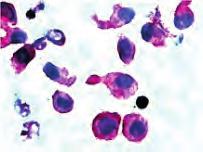 Prekurske limfoidne neoplazme: a, b) punktat KS - akutna pre-b limfatična leukemija (MGG x1000); c) imunocitokemijski CD10 pozivni limfoblasti (LSAB x1000); d) punktat KS - akutna T