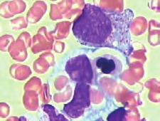 I. Kardum-Skelin i suradnici Citologija u pedijatrijskoj onkologiji Hemofagocitna limfohistiocitoza Hemofagocitna limfohistiocitoza (HLH) je potencijalno smrtonosna bolest, čije je rano prepoznavanje