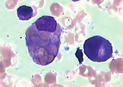 Familijarna hemofagocitna limfohistiocitoza (FLH) je autosomno recesivna nasljedna multisistemska bolest. PRF1, UNC13D i STX11 genski defekti nalaze se u podlozi 40-50% slučajeva FLH (5,6).
