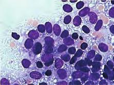 small round cell tumors - SRCT) koji uključuju: Ewingov sarkom/primitivni neuroektodermalni tumor, neuroblastom, maligni limfom, nefroblastom (Wilmsov tumor), hepatoblastom, rabdomiosarkom,